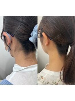 ミース 福岡本店/うなじ矯正◆ビフォーアフター