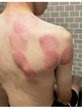 アクティボ(Actibo)/カッピングによる筋膜リリース