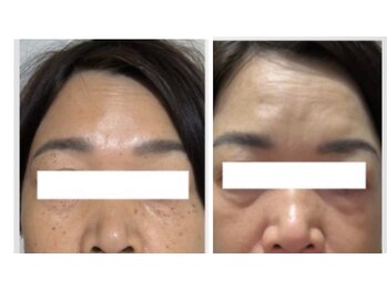 サロン リノ(salon rino)の写真/結果重視◎格上のシミ改善体験！7日後の変化。60日後の確かな結果へ。隠す肌から自信の持てる素肌へ！