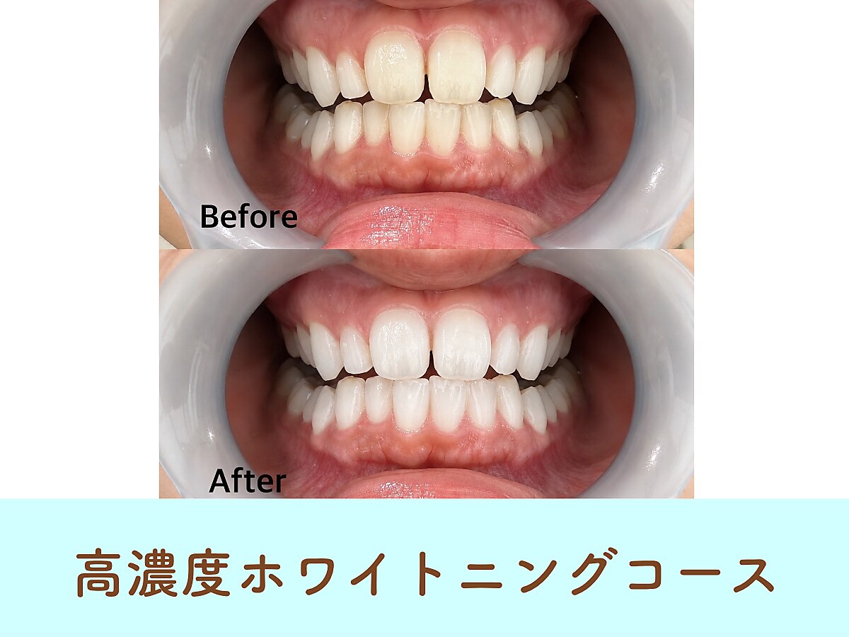 <初めての方やイベント前に>高濃度ホワイトニングコース 通常\20,800→