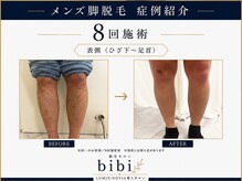 ビビ(bibi)/メンズ足脱毛施術8回（表側）
