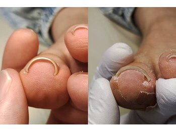 フルフィル 北千住/巻き爪　Befre　After