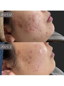 ラ クレール ビューティーサロン(LA CLAIR)/肌改善コース(ニキビケア).