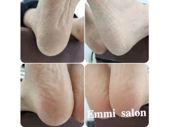 エミー(emmi)の写真/★フットケアメニューが新登場★臭いやザラつきが気になる足裏の角質を、綺麗に取り除いてツルツルの足へ♪