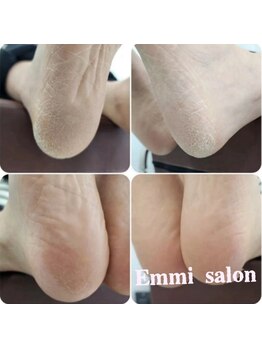 角質ケアができるサロン