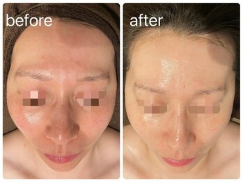 エヌエースキン たまプラーザ店(NAskin)/ハーブピーリング|美白ケア