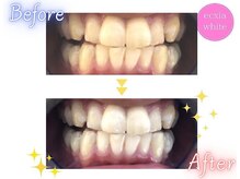 エクシアホワイトニング 明石店/ホワイトニング体験/記念写真