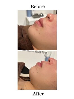 ハリムーン 仙台(harimoon)/ニキビケア