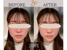 チョコバリ 新宿店(chocobari)/小顔×リフトアップ(美容鍼)20代