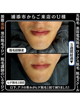 ディースタイル 北谷店(Dstyle)/北谷メンズ脱毛ヒゲBefore after