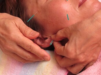 クローブ鍼灸院(CLOVE鍼灸院)の写真/食いしばり・エラの張り・疲れ顔など輪郭のもたつきのお悩みに!小顔に特化した美容鍼で施術後に効果実感◎