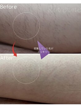 リヴェーヌ 呉羽店(Riverne)/【脱毛】自己処理卒業へ