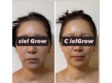 シエルグロウ(CielGrow)/acトリートメント
