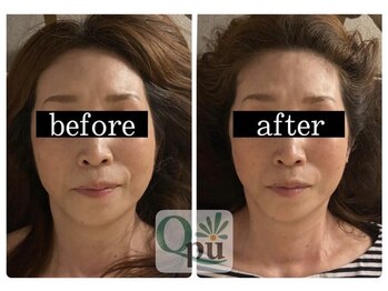 キュープ 大阪中百舌鳥店(Qpu)/通いやすい料金システム 小顔