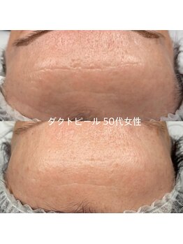 ソアン(Soin)/ダクトピール