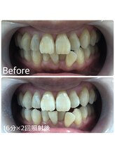 ホワイトニングカフェ 岸和田店(WhiteningCafe)/16分×2回照射