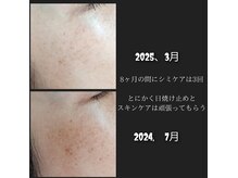 ナイン(nine)の雰囲気（何もしなければシミは増え続けます）