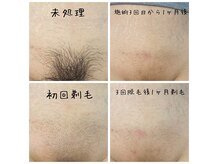 ブロッサム(BLOSSOM)の雰囲気(脱毛するだけで、こんなに気持ちが軽くなる)