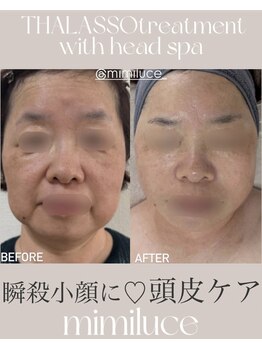 ミミルーチェ(mimiluce)/タラソと美脳小顔ヘッドスパset