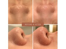 サンスエイジ(Sans age)の雰囲気（毛穴洗浄　1回施術後 &nbsp;&nbsp;トルネード水流で毛穴丸ごと洗い♪）