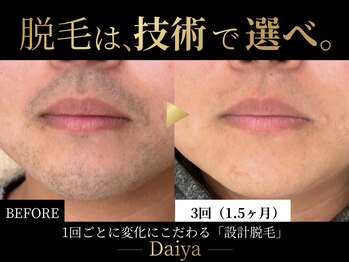 ダイヤ 名古屋中川区店(Daiya)の写真/「効果×技術」で選ぶ設計脱毛｜1回で変化実感、3回で減毛！結果にこだわる大人のメンズ脱毛｜完全都度払い
