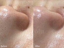 オルオル('Olu'Olu)の雰囲気（黒ずみ・詰まり・開き毛穴に。毛穴の状態を見極めて徹底ケア）