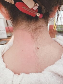 プトゥリ(Putri)/うなじWax脱毛