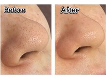 クリニカルホワイトケア(クリニカルWHITEケア)/毛穴洗浄