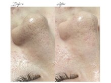 ビズビズ 梅田店(bisebise)/<症例>毛穴詰まり・黒ずみ