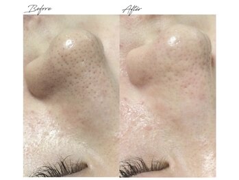 ビズビズ 梅田店(bisebise)/<症例>毛穴詰まり・黒ずみ