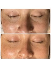 ファスモ(FASMO)/ハーブピーリング（1回目）脱毛