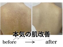 アルゴ 八幡黒崎店(ALGO)/本気の肌改善
