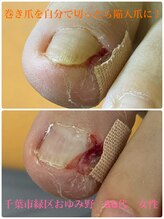 巻き爪じゅん 船橋店/巻き爪自分で切ったら陥入爪に！