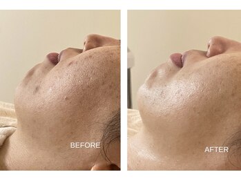 エモベーシック(e'MO BASIC)/シミ/くすみ色素沈着に効果◎