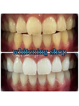 ホワイトニングショップ 吉祥寺店/BEFORE ＆ AFTER