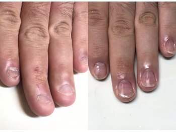 ティアラネイル 宇都宮/深爪矯正