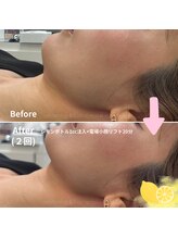 ハピネス 心斎橋アメリカ村本店(Happiness)/レモンボトル