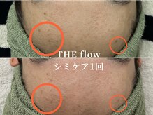 ザ フロウ(THE flow)/シミケア1回｜before/after