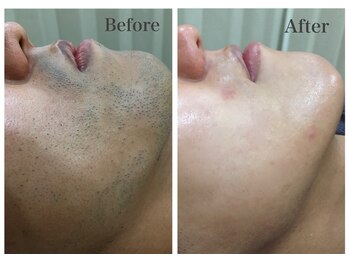 ハダハダ(HADA HADA Medical Esthetic)/どんな青髭でもお任せ下さい♪