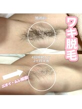 サロン(SALON)/メンズ脱毛：ワキ