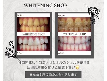 ホワイトニング ショップ 金沢店/ご紹介で回数アップ！！