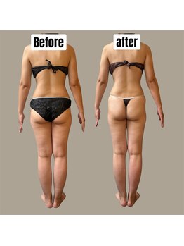 ベオ(Salon Beo)/下半身モニター様