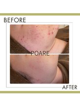 ポアレ(POARE)/繰り返すニキビ