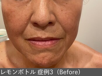 オアシスラグーン(OASIS LAGOON)/レモンボトル(症例3 before)