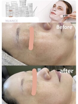 ミコサロン(miko salon)の写真/ゆるんだお肌が引き締り透明感もアップ！肌本来の力を引き出す!たるみ/シワ/シミ/くすみの改善に！