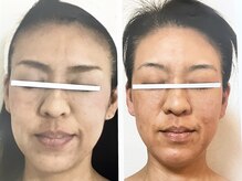 ダルセーニョ/コルギ施術８回目　Before-After