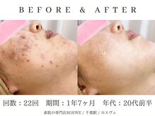 ロエヴェ(ROEWE)/ニキビ改善・毛穴ケア・肌質改善