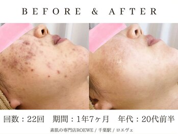 ロエヴェ(ROEWE)/ニキビ改善・毛穴ケア・肌質改善