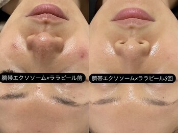 グラン ジュテ/臍帯エクソソーム×ララピール