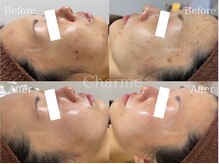 シャルム(Charme.)の雰囲気（あらゆる肌トラブル改善に対応可能◎次世代ハーブピーリング）